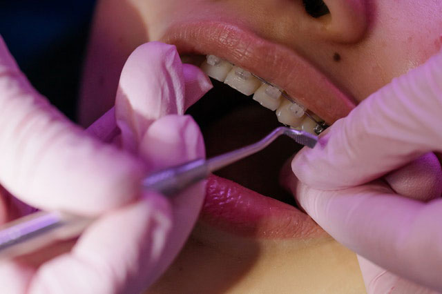 A dentist fixing braces