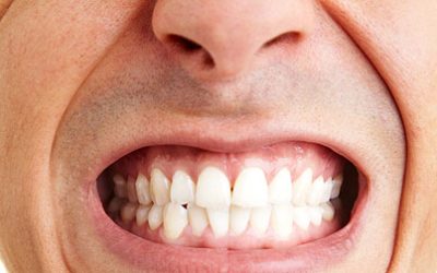 What is bruxism (teeth grinding)?