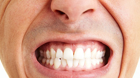 What is bruxism (teeth grinding)?